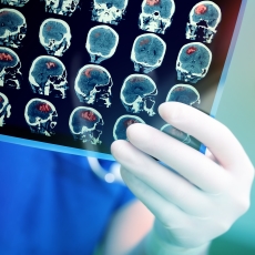Neuroma acústico