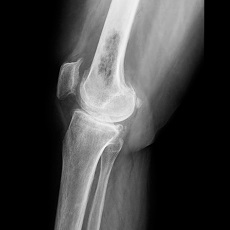 Cáncer de hueso