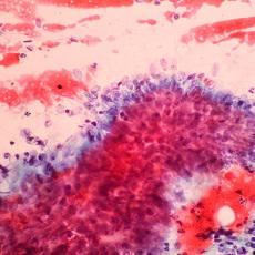 Cáncer de cuello uterino