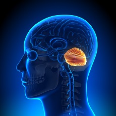 Malformaciones de Chiari