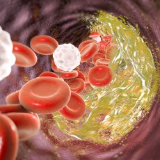 Enfermedad de las arterias coronarias