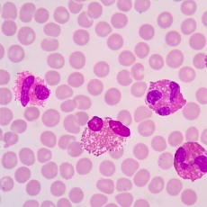 Desórdenes eosinofílicos