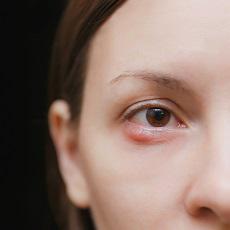 Infecciones de los ojos