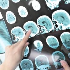 Accidente cerebrovascular hemorrágico