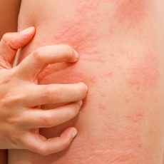 Urticaria