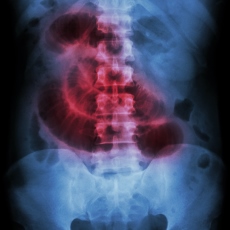 Obstrucción intestinal