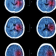 Accidente cerebrovascular isquémico