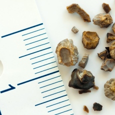 Piedras en los riñones