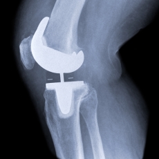 Reemplazo de rodilla