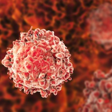Leucemia mielógena aguda