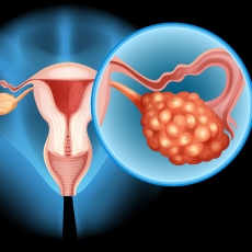 Cáncer de ovario