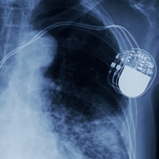Marcapasos y desfibrilador implantable