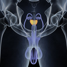 Cáncer de próstata