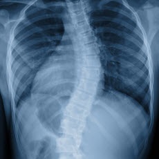 Escoliosis