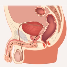 Cáncer de testículo
