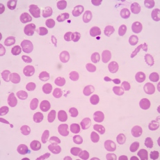 Talasemia