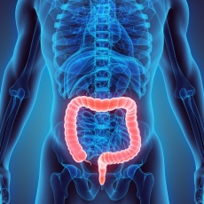 Colitis ulcerativa