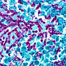 Infecciones por cándida