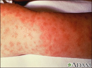Fiebre maculosa de las Montañas Rocosas - lesiones en el brazo Fiebre maculosa de las Montañas Rocosas - lesiones en el brazo