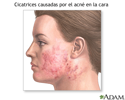 Cirugía para suavizar la superficie de la piel (dermabrasión) - Serie - Indicaciones Cirugía para suavizar la superficie de la piel (dermabrasión) - Serie - Indicaciones