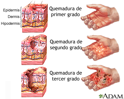 Quemaduras Quemaduras