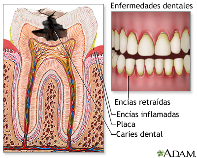 Gingivitis Gingivitis