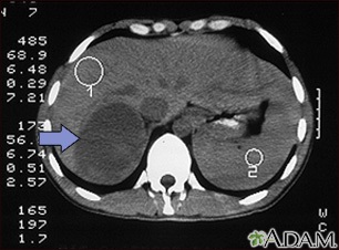 Tumor suprarenal - TC Tumor suprarenal - TC