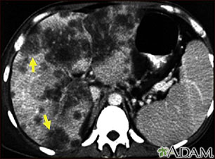 Cáncer hepatocelular - TC Cáncer hepatocelular - TC