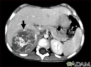 Tomografía computarizada de neuroblastoma en el hígado Tomografía computarizada de neuroblastoma en el hígado