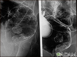 Rayos X - de un cáncer rectal Rayos X - de un cáncer rectal