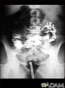 Radiografía de vólvulo Radiografía de vólvulo