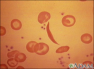 Glóbulos rojos drepanocíticos Glóbulos rojos drepanocíticos
