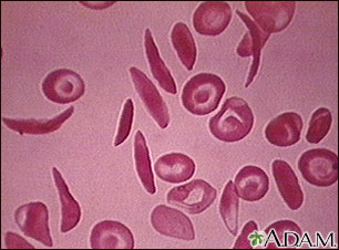 Glóbulos rojos - drepanocíticos múltiples Glóbulos rojos - drepanocíticos múltiples