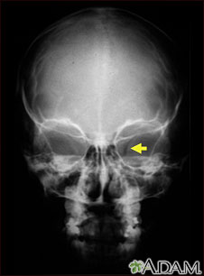 Neurofibromatosis I - agrandamiento de la abertura óptica Neurofibromatosis I - agrandamiento de la abertura óptica