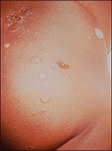 Impetigo - ampollas en las nalgas Impetigo - ampollas en las nalgas