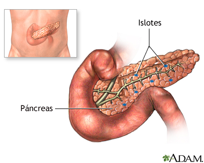 Trasplante de páncreas - serie Trasplante de páncreas - serie