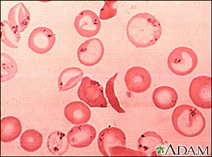Glóbulos rojos - falciformes y cuerpos de Pappenheimer Glóbulos rojos - falciformes y cuerpos de Pappenheimer
