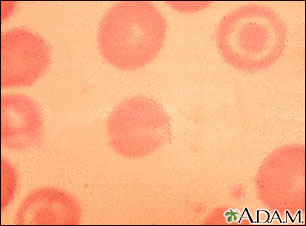 Glóbulos rojos de la sangre, células en diana Glóbulos rojos de la sangre, células en diana