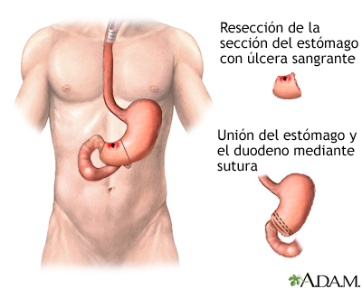 Procedimiento (tercera parte) Procedimiento (tercera parte)