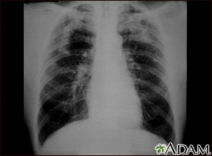 Neumoconiosis complicada del minero Neumoconiosis complicada del minero