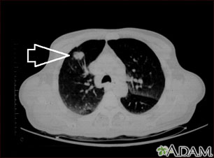 Masa pulmonar, lóbulo superior derecho - Tomografía computarizada Masa pulmonar, lóbulo superior derecho - Tomografía computarizada