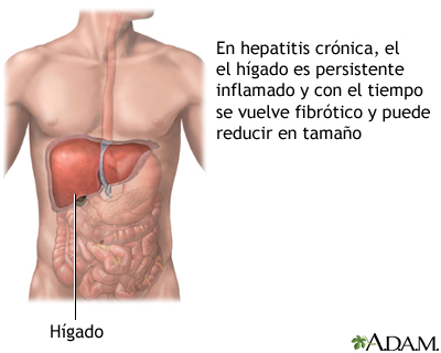 Hepatitis crónica Hepatitis crónica