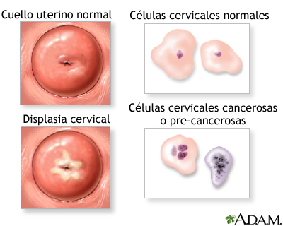 Neoplasia cervical Neoplasia cervical