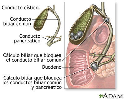 Coledocolitiasis Coledocolitiasis
