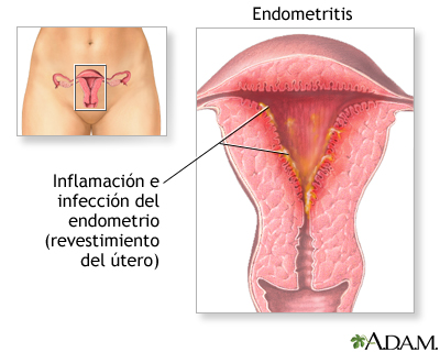 Endometritis Endometritis