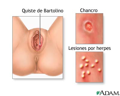 Llagas genitales (en mujeres) Llagas genitales (en mujeres)