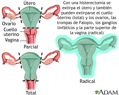 Histerectomía Histerectomía