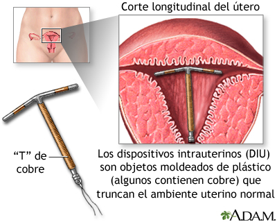 Dispositivos intrauterinos Dispositivos intrauterinos