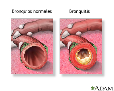 Bronquitis Bronquitis