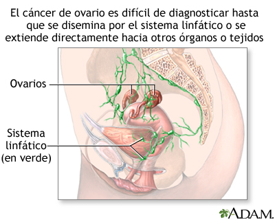 Peligros del cáncer de ovario Peligros del cáncer de ovario
